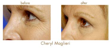 Before and after using Hydroderm